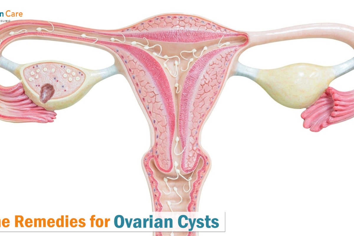 Home Remedies for Ovarian Cysts