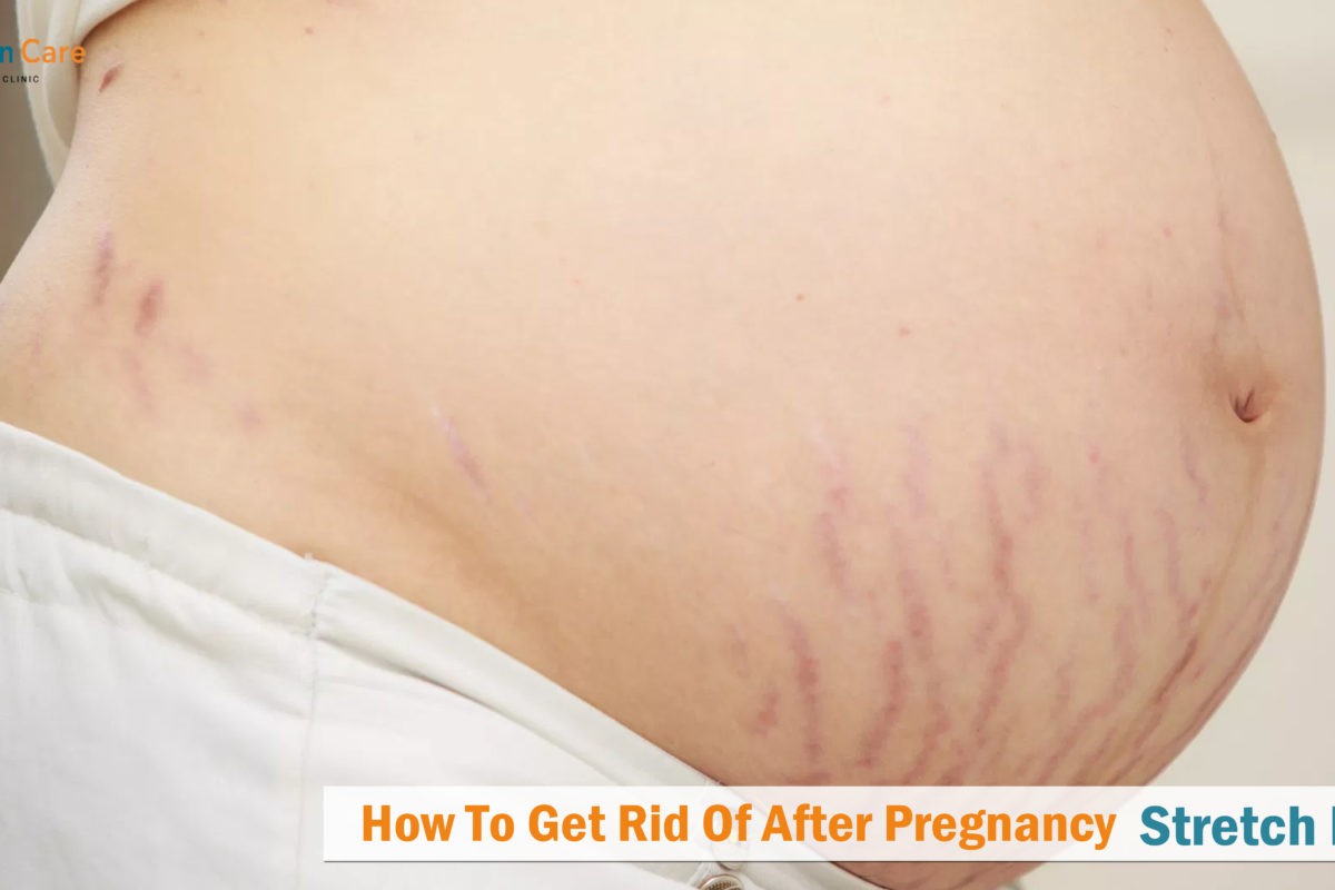 How To Get Rid Of After Pregnancy Stretch Marks