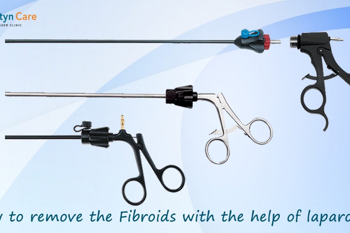 How to remove the Fibroids with the help of laparoscopy