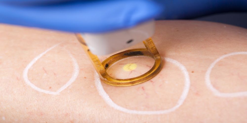 laser treatment of spider veins