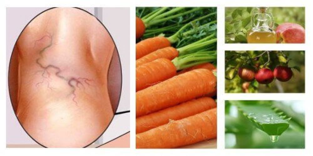natural treatment for spider veins-foods to eat for spider veins