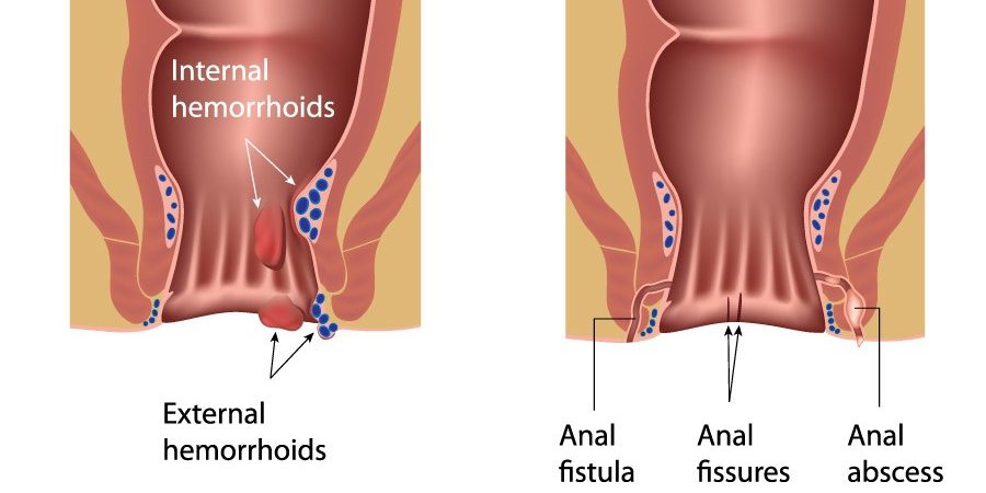 Anal disorders