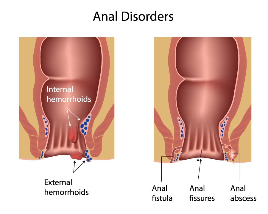 Anal disorders