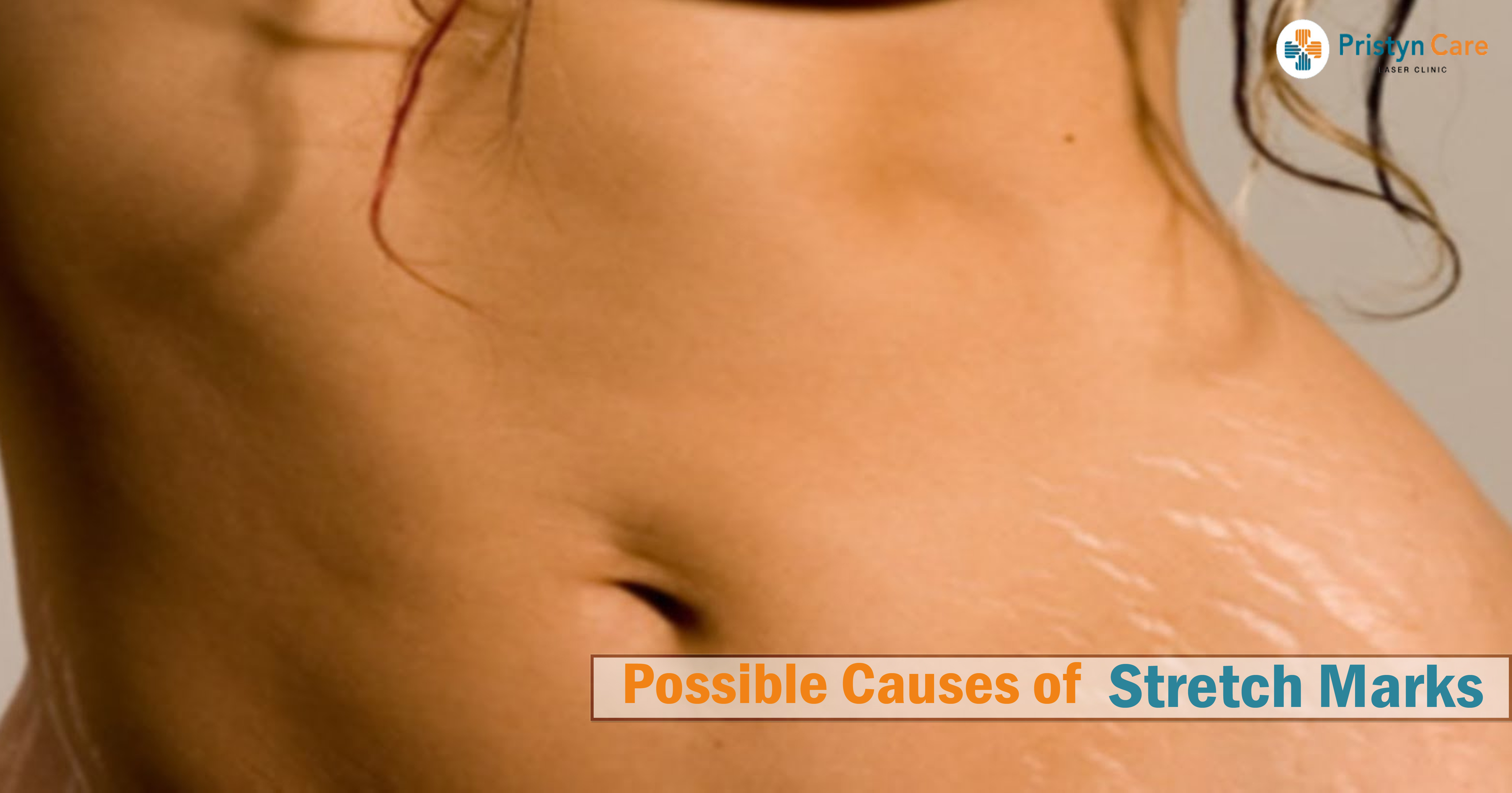 possible-causes-of-stretch-marks