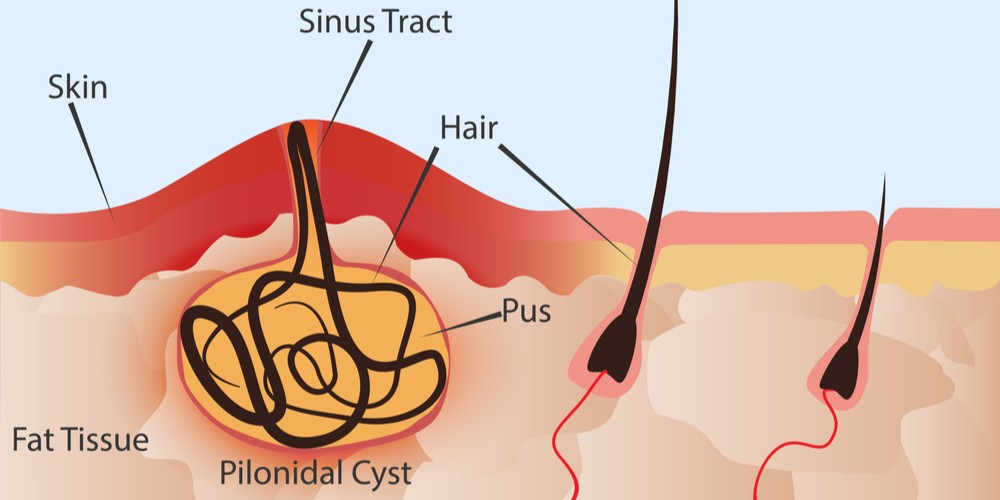 Pilonidal Sinus structure