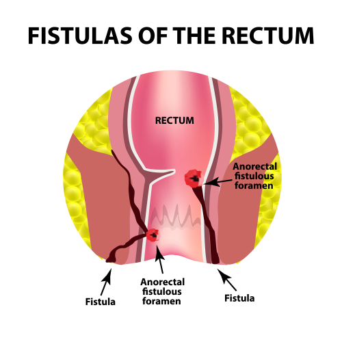 anal fistula