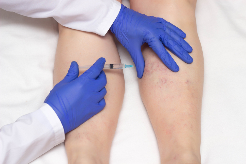 sclerotherapy for spider veins