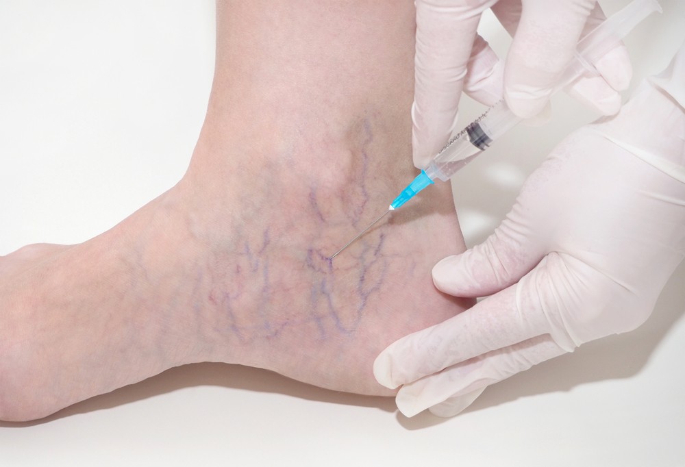 sclerotherapy for spider veins