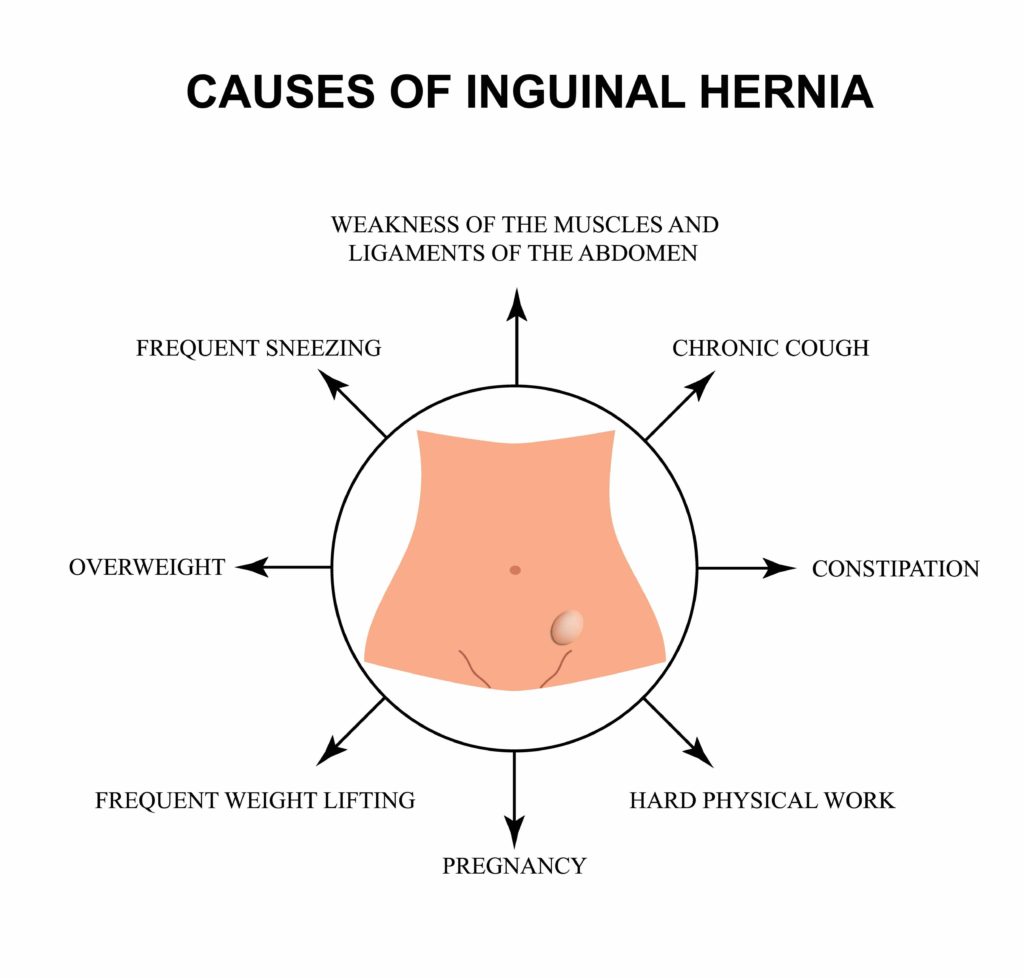 Common Types Of Hernia In Men Know Completely