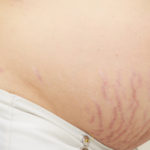 r Pregnancy Stretch Marks