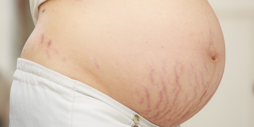 r Pregnancy Stretch Marks