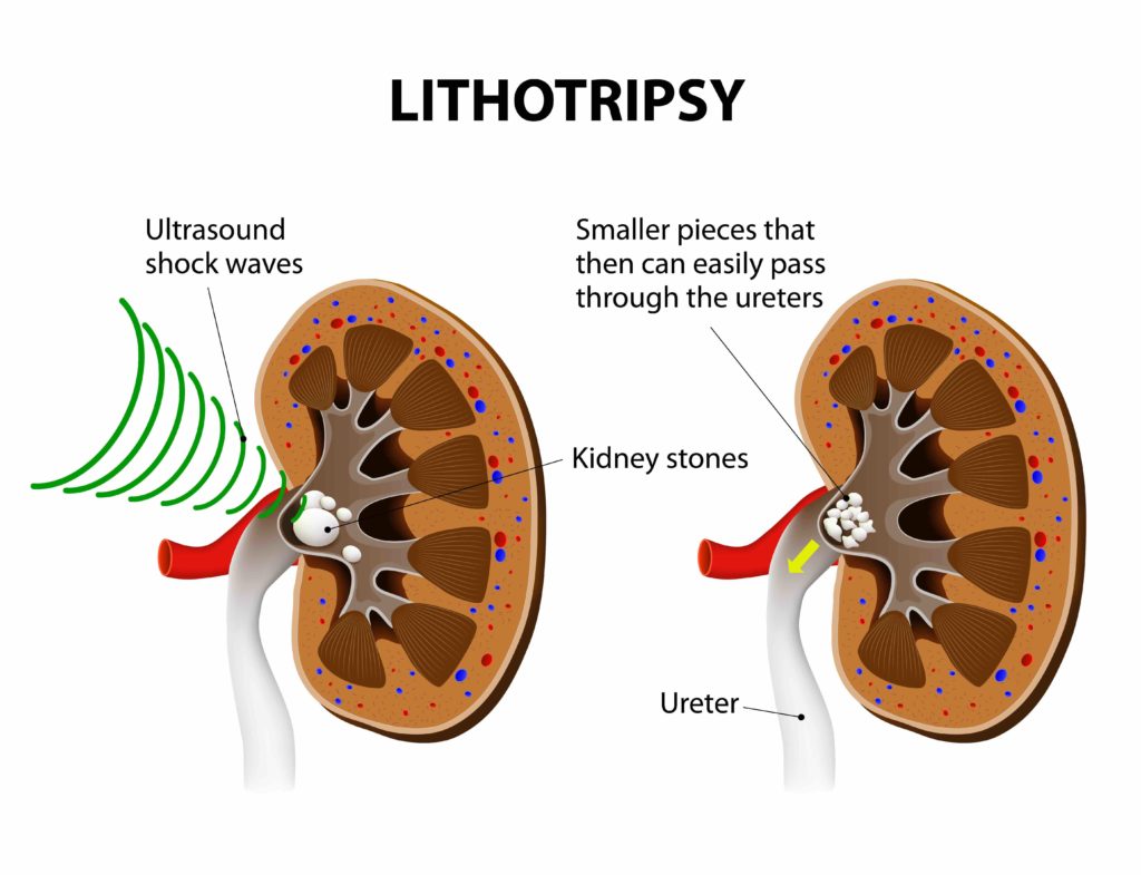 lithotripsy-kidney stone treatment