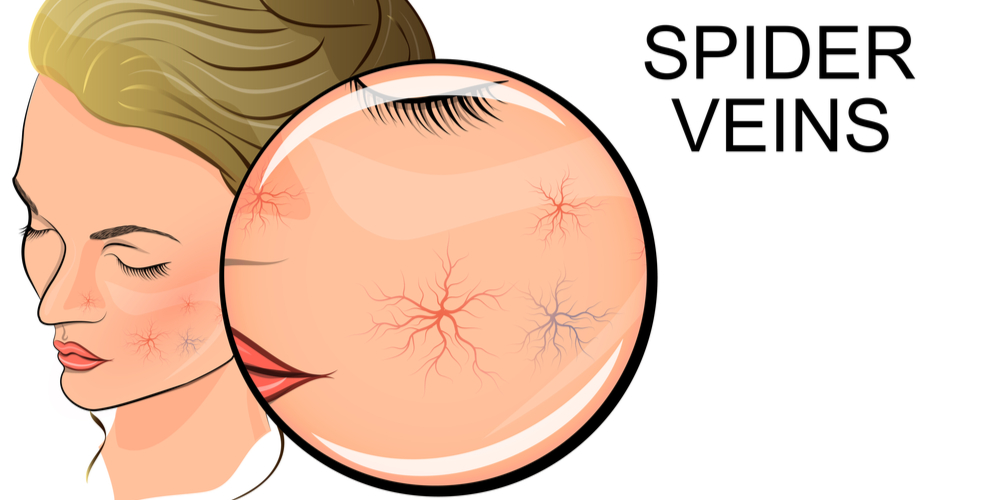 spider veins on face