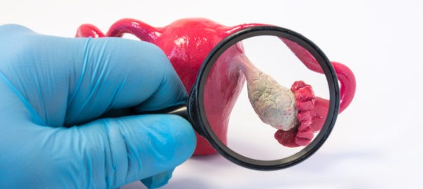 Home Remedies for Ovarian Cysts