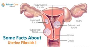 some-facts-about-uterine-fibroids