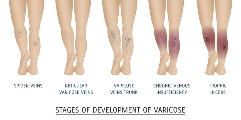 spider veins in legs-varicose veins