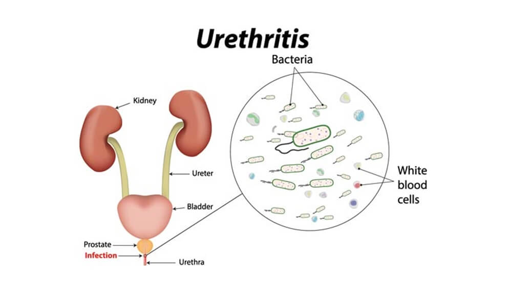 urethritis treatment