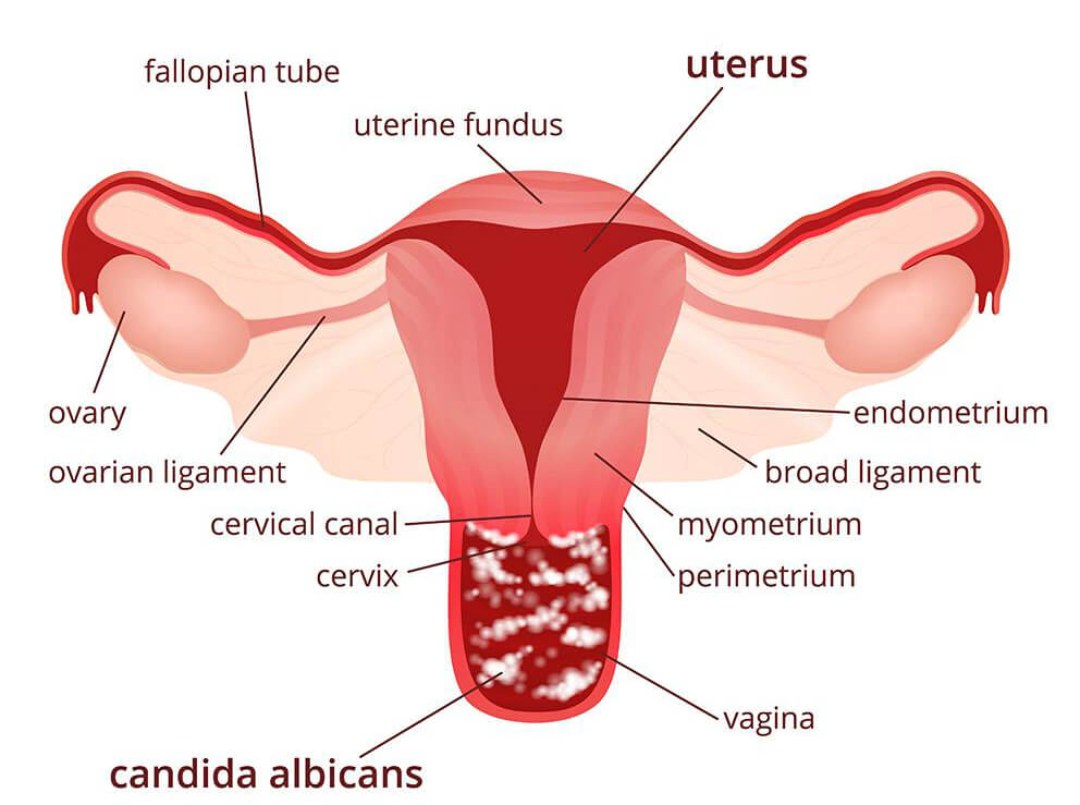 vaginal yeast infection symptoms