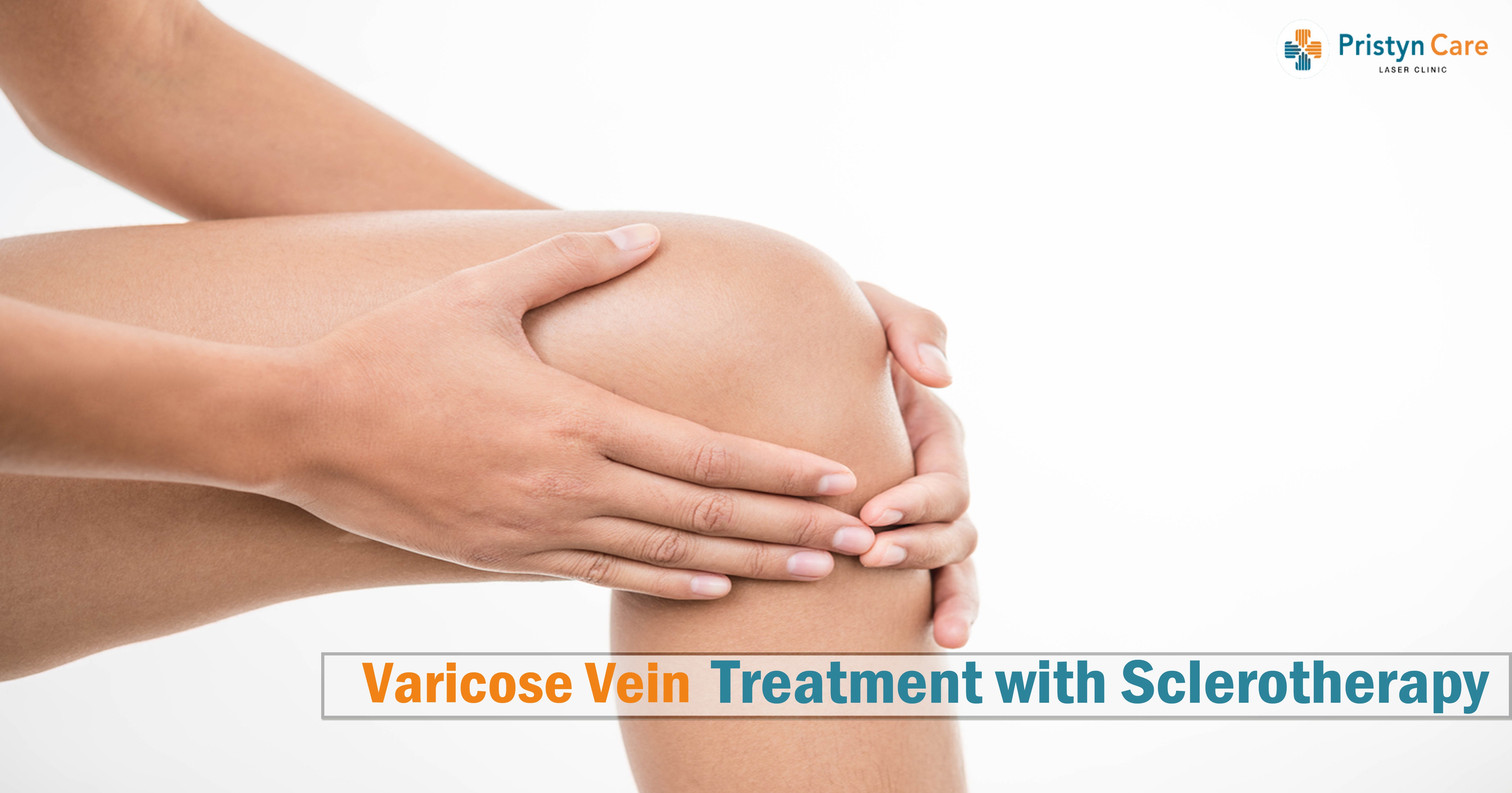 varicose veins with treatment