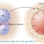 what-factors-are-responsible-for-the-growth-of-pilonidal-cyst-or-sinus-min