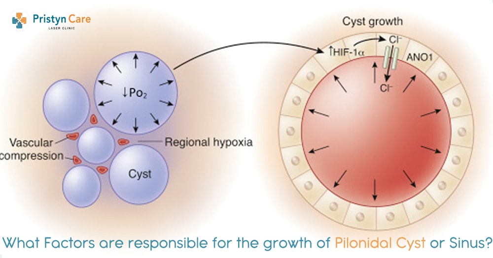 what-factors-are-responsible-for-the-growth-of-pilonidal-cyst-or-sinus-min