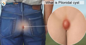 what-is-pilonidaal-cyst