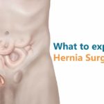 what-to-expect-under-hernia-surgery
