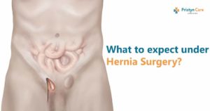 what-to-expect-under-hernia-surgery
