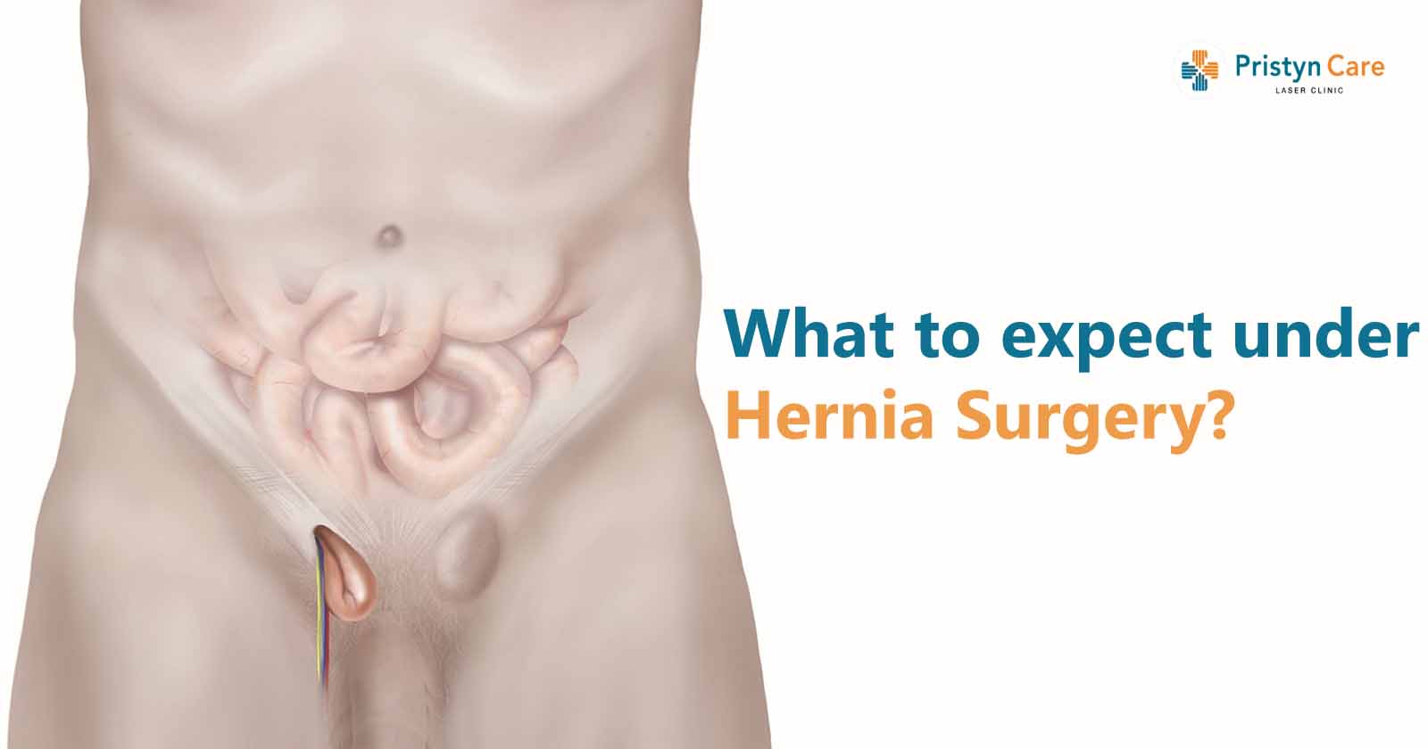 what-to-expect-under-hernia-surgery