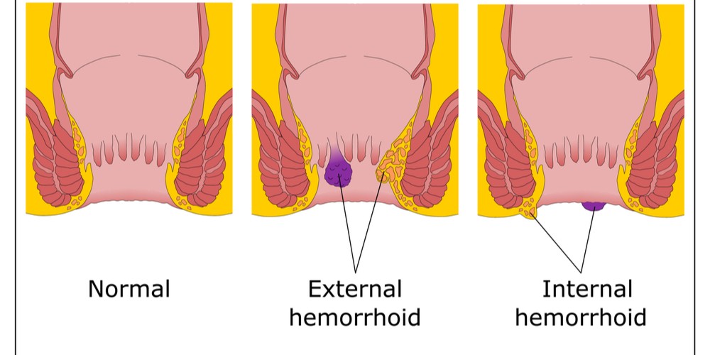 Types of Hemorrhoids