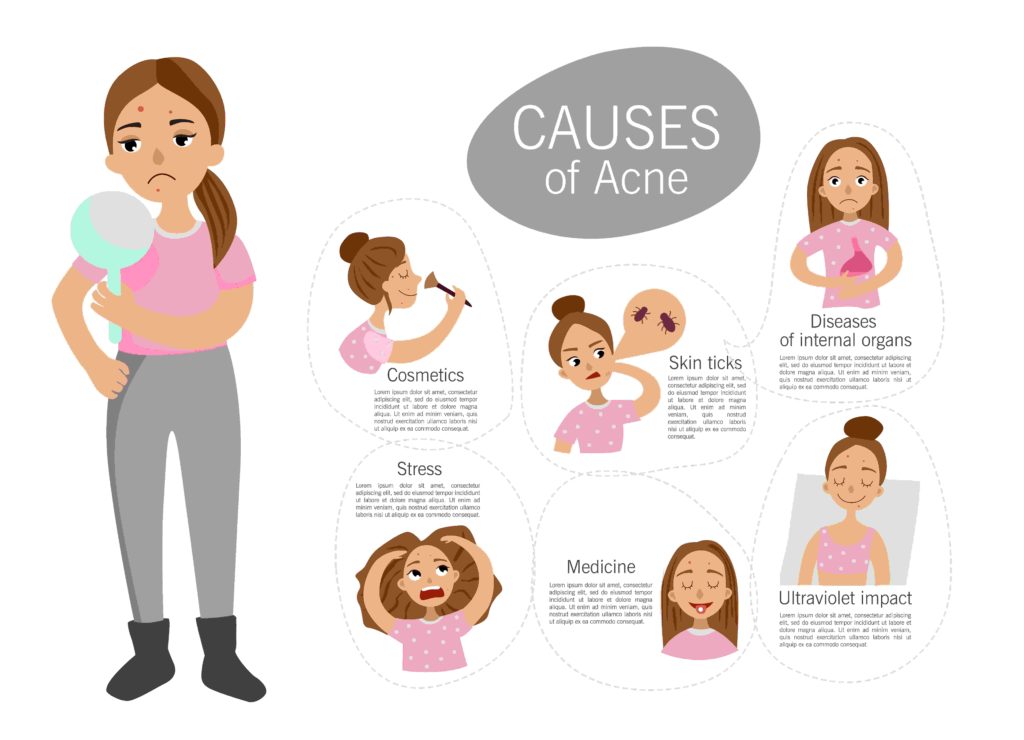 Causes of pimples