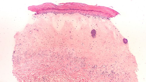 microscopic image of linchen sclerosis 
