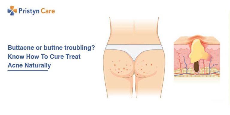 Buttacne or buttne troubling? Know How To Cure Treat Acne Naturally