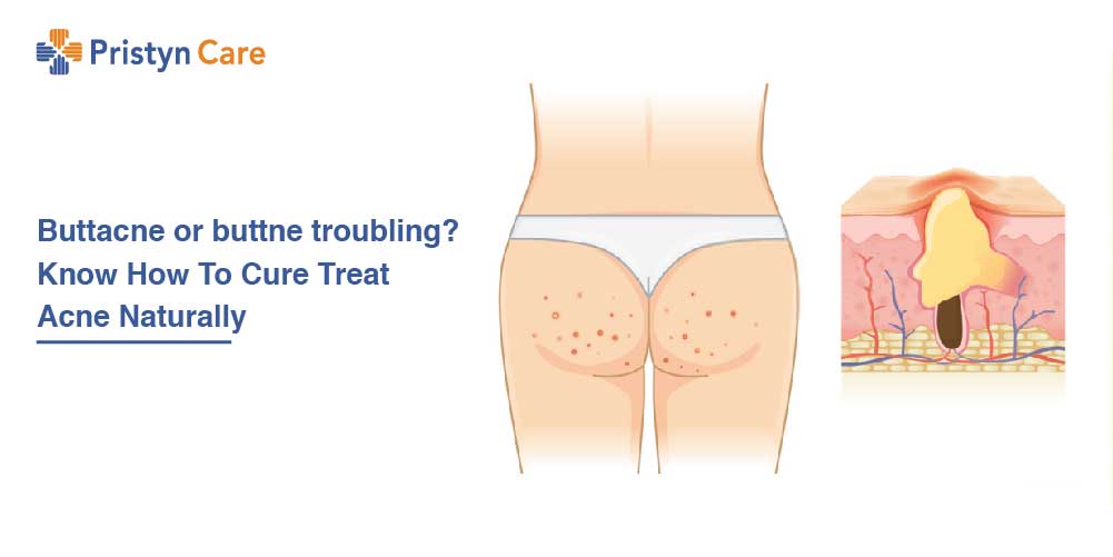 Buttacne or buttne troubling? Know How To Cure Treat Acne Naturally