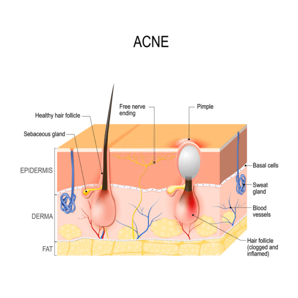 inflammed hair follicle