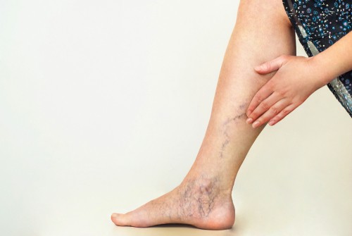Can Birth Control Pills Cause Varicose Veins Pristyn Care