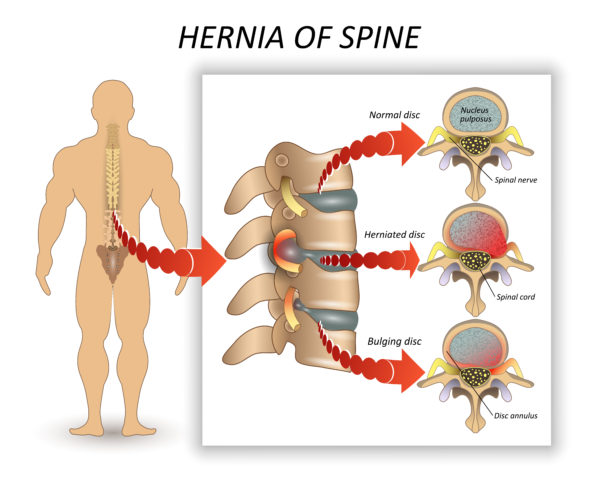 How a spine gets herniated