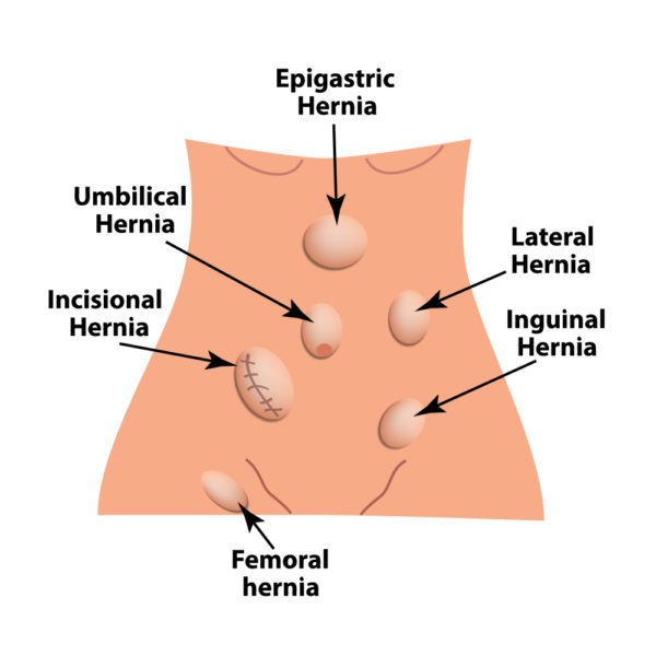 the types of hernia