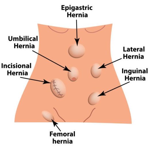location of different hernia in the body