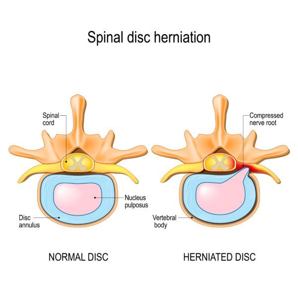 normal vs herniated disc