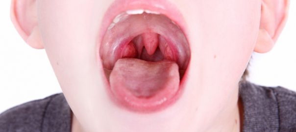10 Home Remedies For Tonsils (Tonsillitis)