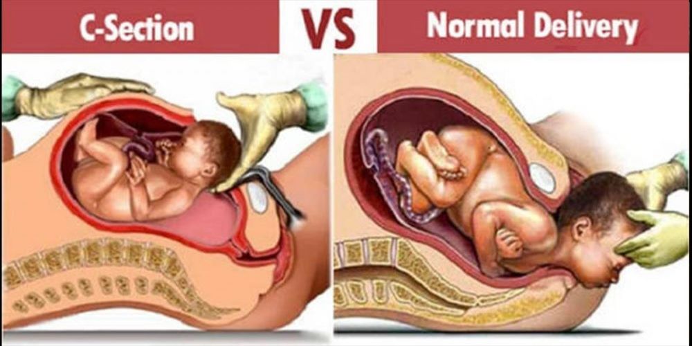 Normal delivery vs C-section