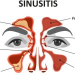 cover-image-for-effectiveness-of-balloon-sinuplasty