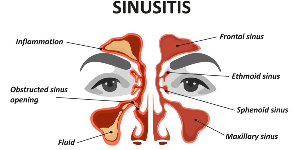 How Effective Is Balloon Sinuplasty In India Pristyn Care