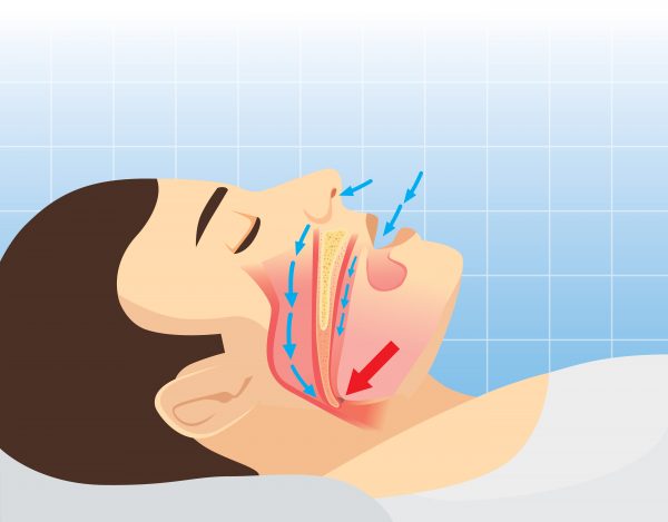 snoring diagram