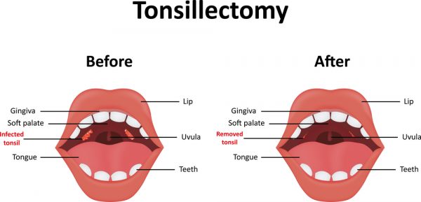 tonsillectomy for peritonsillar abscess