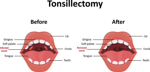 tonsillectomy for peritonsillar abscess