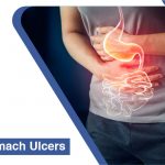 Stomach Ulcers - Pristyn Care