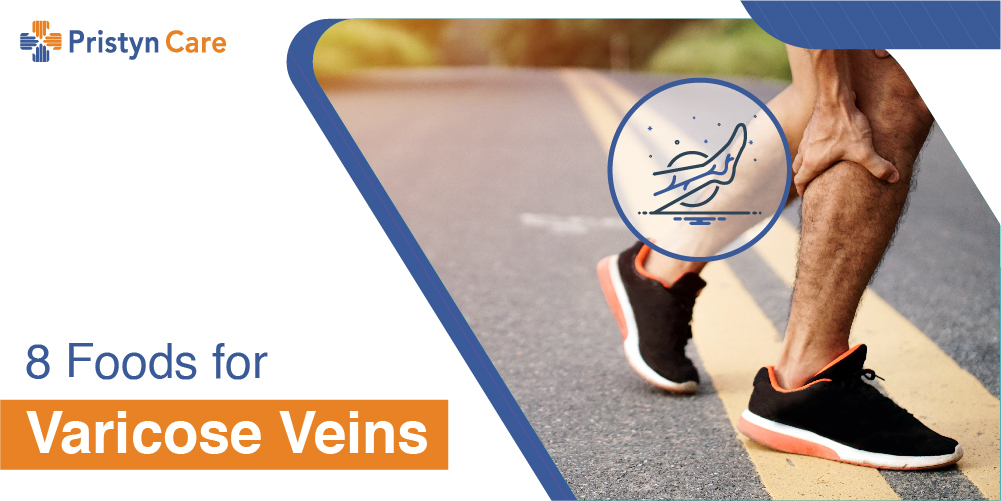 Top 10 ways to prevent varicose veins - Pristyn Care