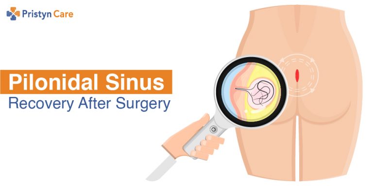 Recovery after Pilonidal sinus surgery